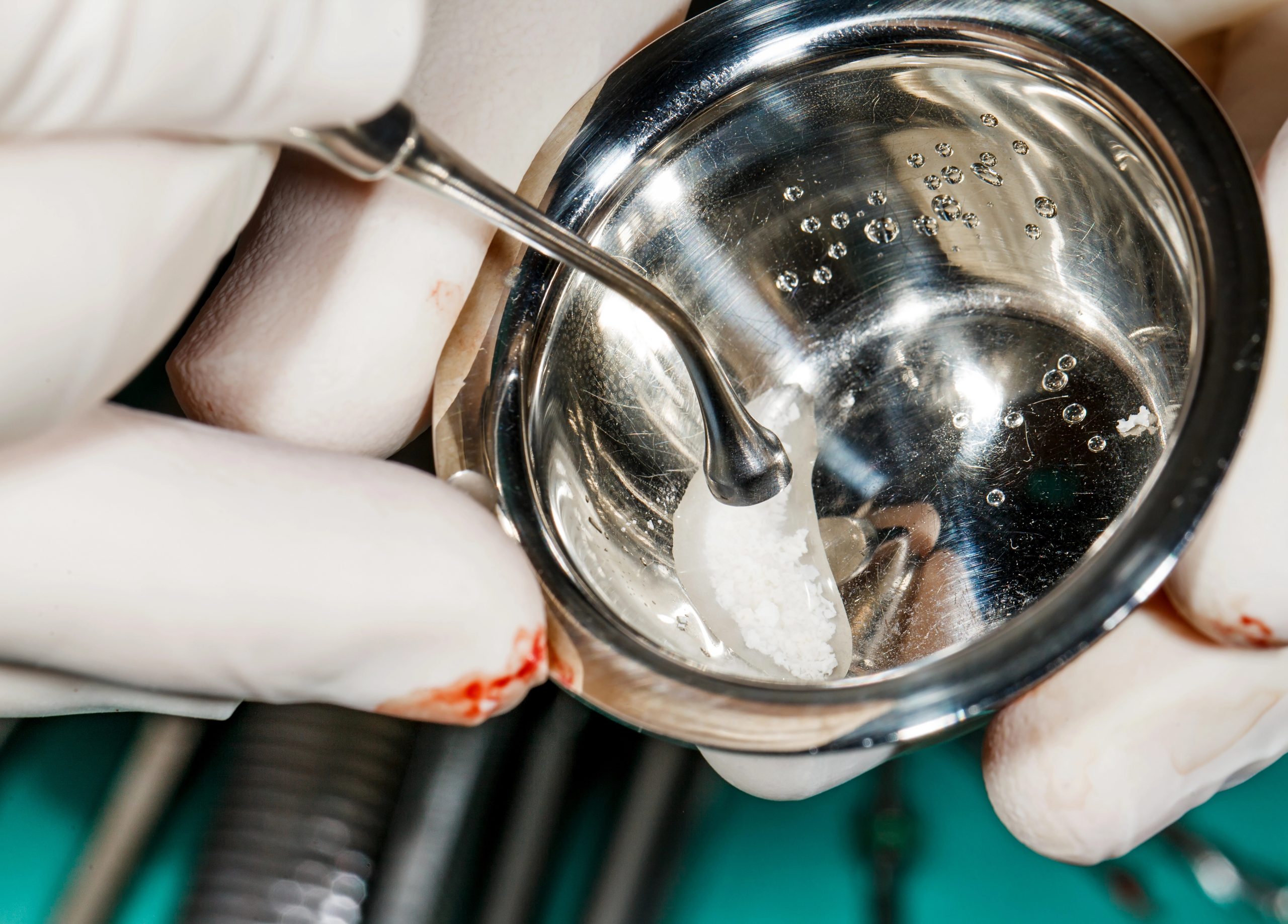 Bone Graft Surgery for Teeth: Enhancing Oral Health and Stability