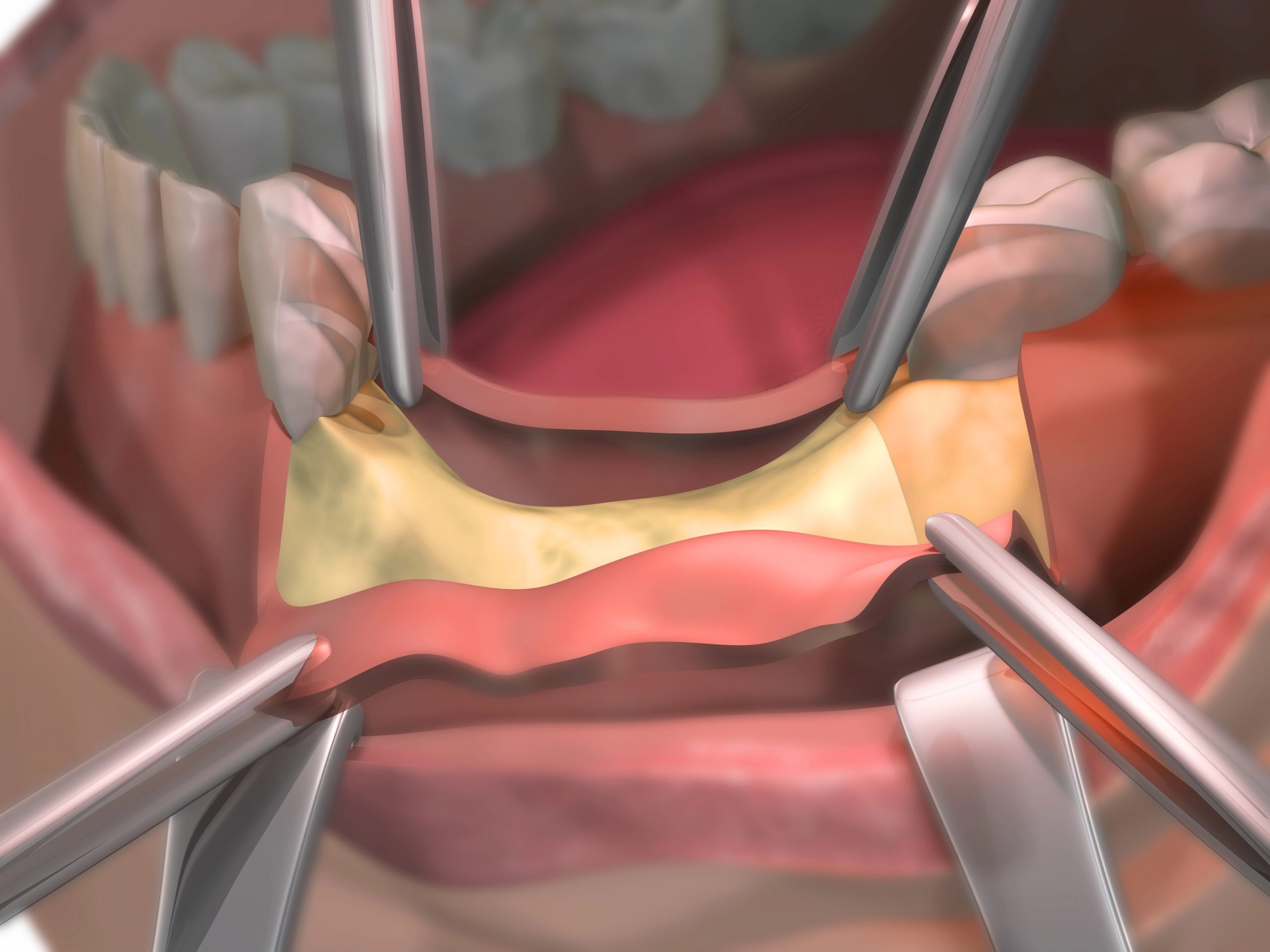 Types of Dental Bone Grafts: Which Option Is Right for You?